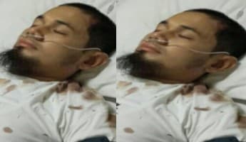 Ditabrak Motor Hingga Pendarahan di Kepala, UGB Harus Terapi