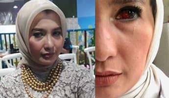 Pembuluh Darah Mata Arzeti Bilbina Pecah di Pesawat, Begini Fotonya