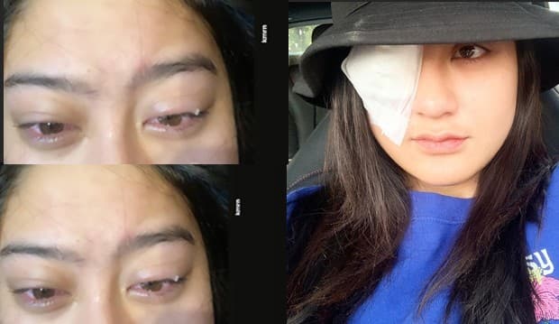 5 Cerita Ngeri Salshabilla Adriani, Nyaris Buta Akibat Softlens Rusak Kornea Mata