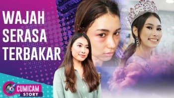 Ngeri! Putri Indonesia 2019 Frederika Alexis Jadi Dugaan Korban Malpraktik, Wajah Serasa Terbakar